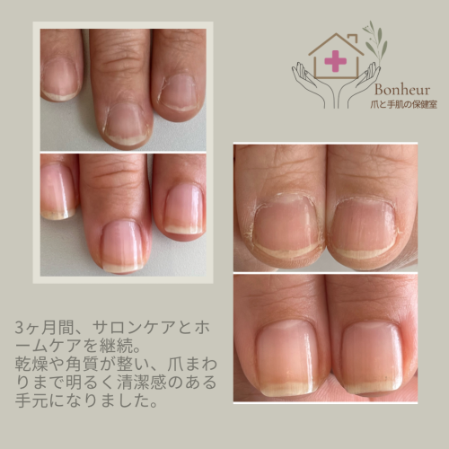 ホーム用爪